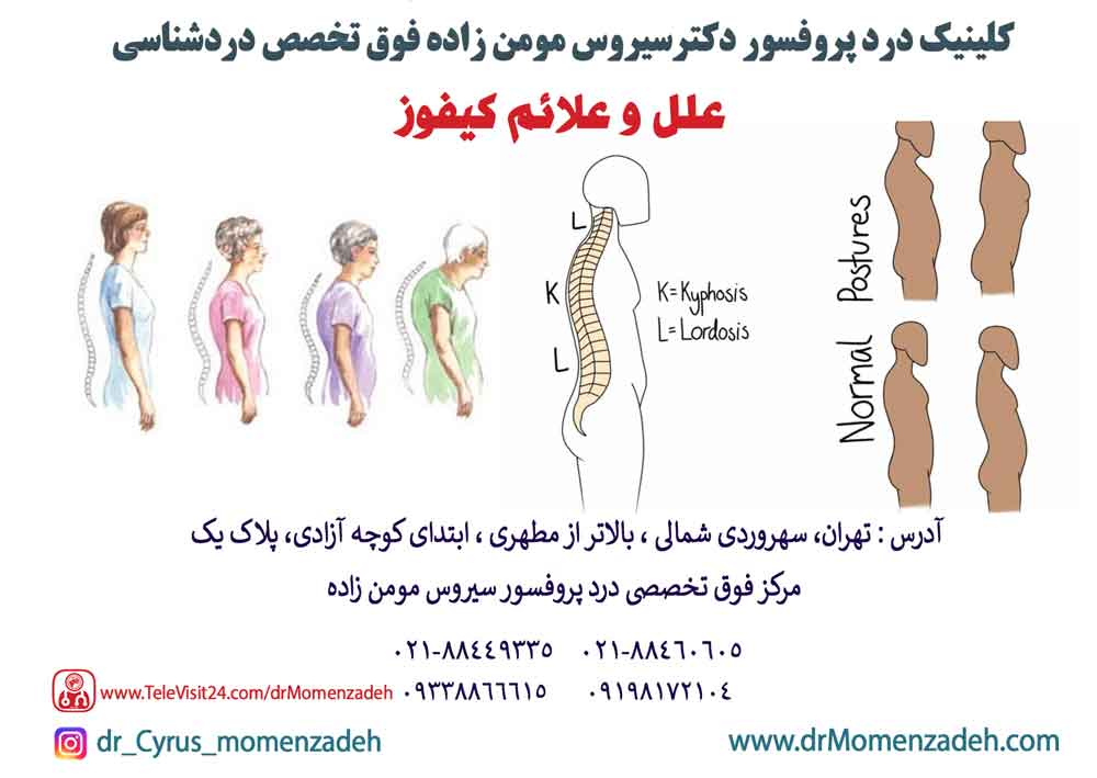 علل و علائم کیفوز یا قوز کمر(گوژپشتی)