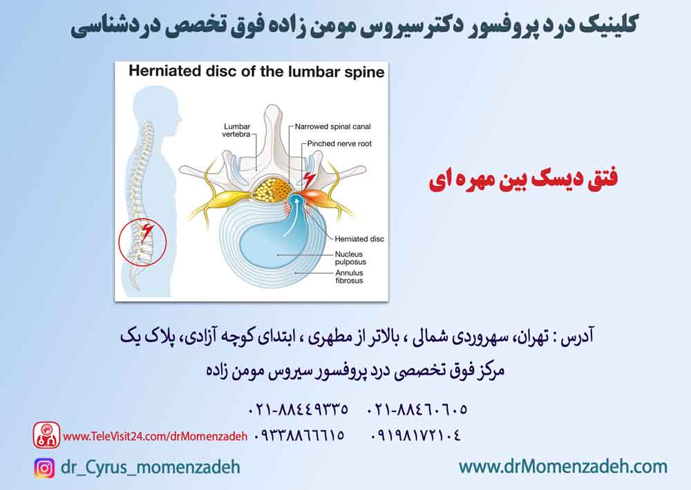 فتق دیسک بین مهره ای