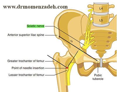 درد سیاتیک, درد پا, درد ران پا, دردباسن, درد بدن